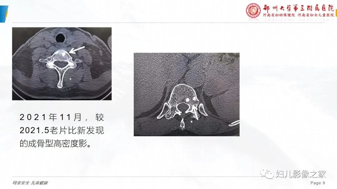 影像PPT - 【PPT】乳腺癌骨转移的假性进展-9