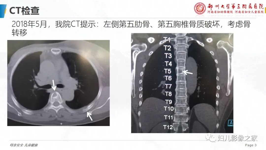 影像PPT - 【PPT】乳腺癌骨转移的假性进展-3