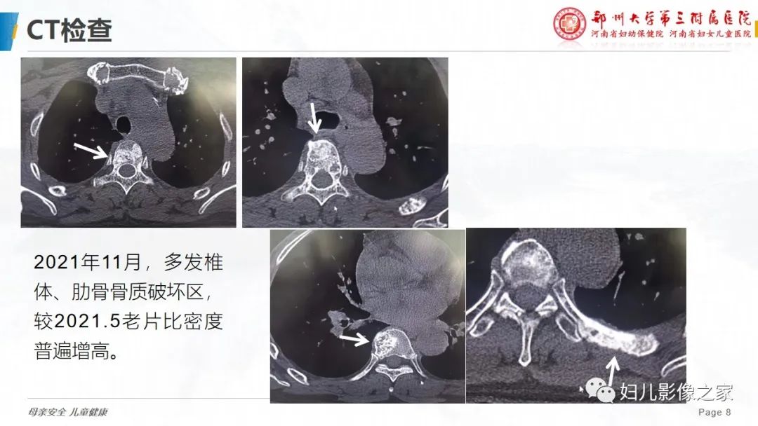 影像PPT - 【PPT】乳腺癌骨转移的假性进展-8