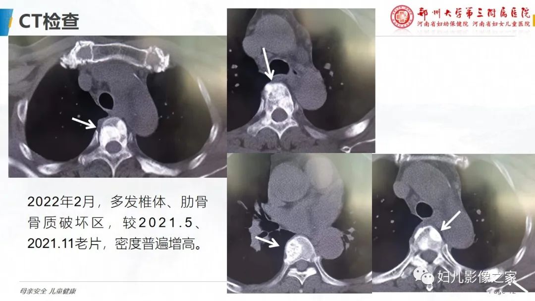 影像PPT - 【PPT】乳腺癌骨转移的假性进展-12