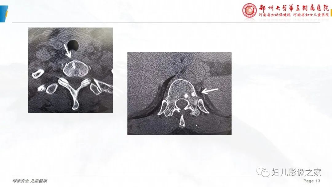 影像PPT - 【PPT】乳腺癌骨转移的假性进展-13