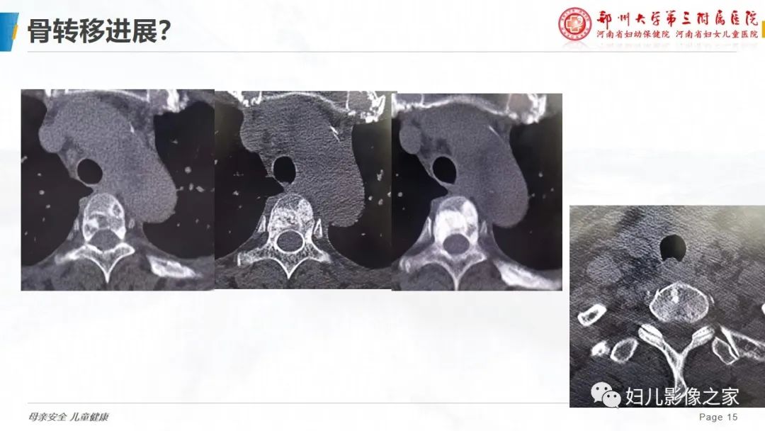 影像PPT - 【PPT】乳腺癌骨转移的假性进展-15