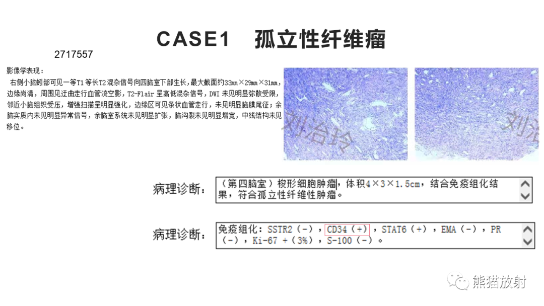 影像PPT - 【病例】四脑室孤立性纤维瘤 VS 小脑蚓部海绵状血管瘤-23