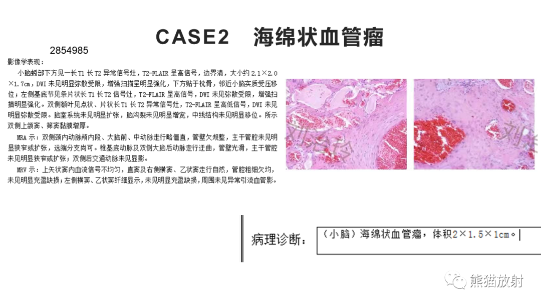 影像PPT - 【病例】四脑室孤立性纤维瘤 VS 小脑蚓部海绵状血管瘤-24
