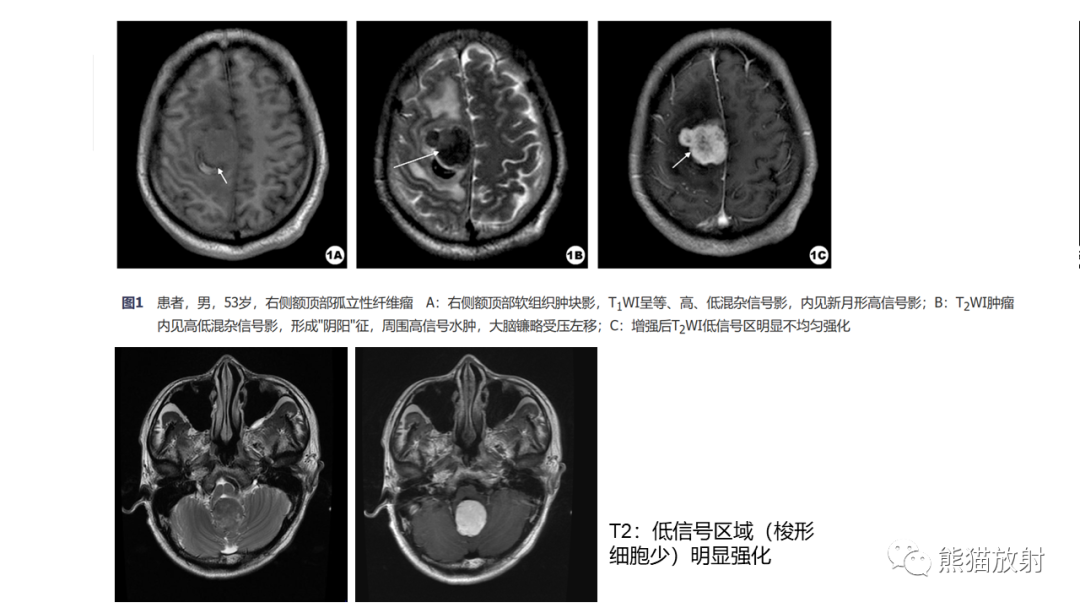 影像PPT - 【病例】四脑室孤立性纤维瘤 VS 小脑蚓部海绵状血管瘤-30