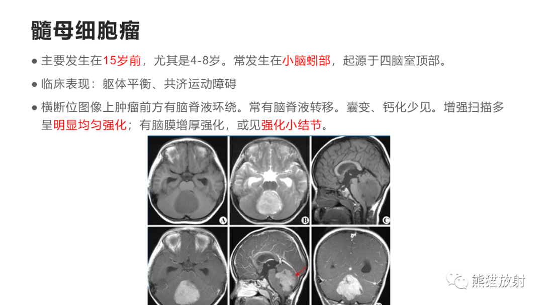 影像PPT - 【病例】四脑室孤立性纤维瘤 VS 小脑蚓部海绵状血管瘤-38