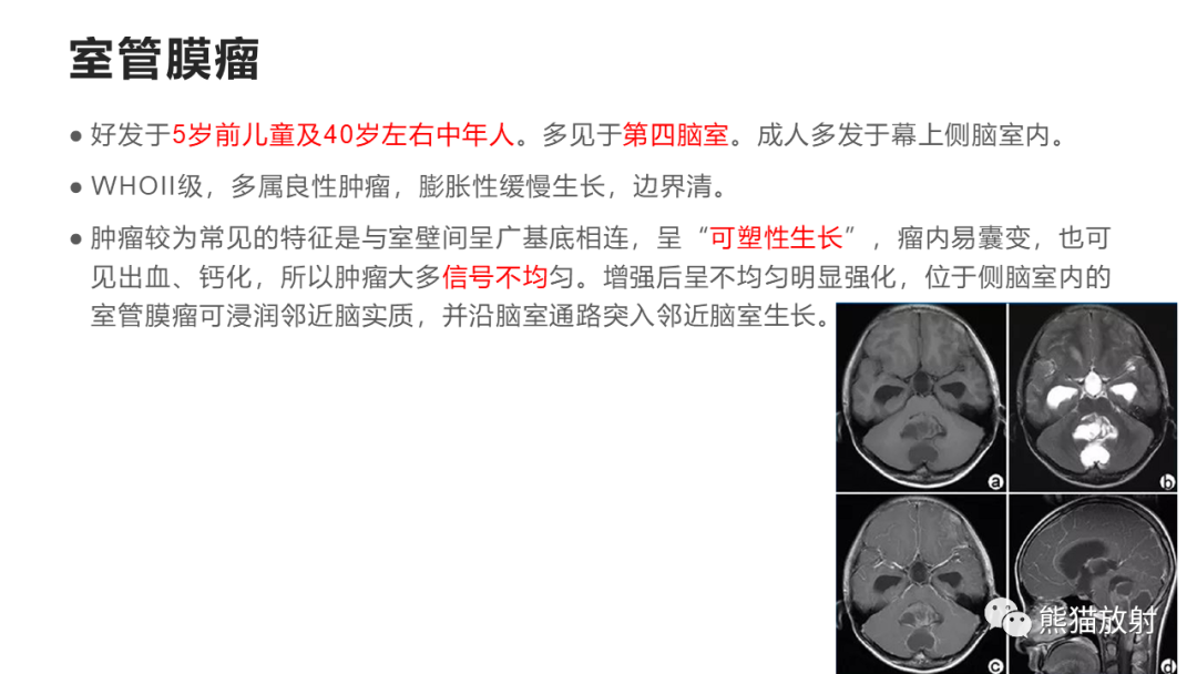 影像PPT - 【病例】四脑室孤立性纤维瘤 VS 小脑蚓部海绵状血管瘤-39