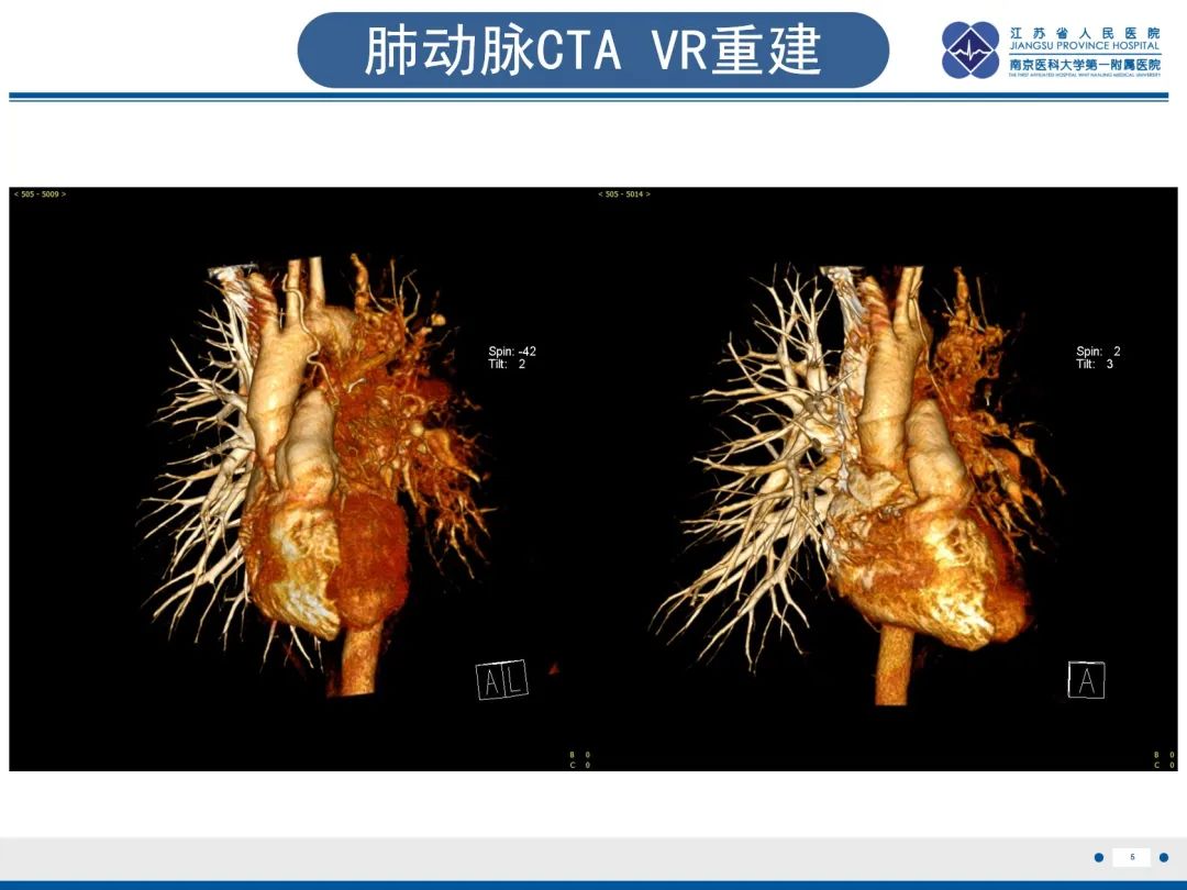 影像PPT - 【PPT】肺动脉内膜肉瘤-6