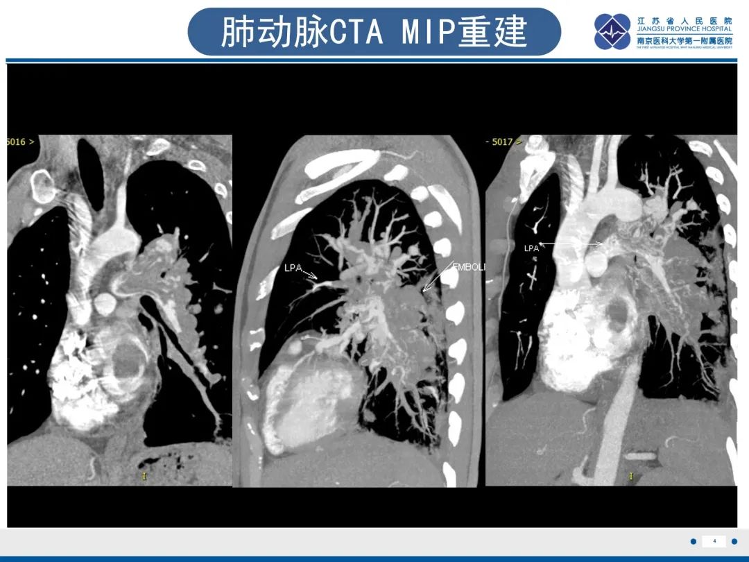 影像PPT - 【PPT】肺动脉内膜肉瘤-5