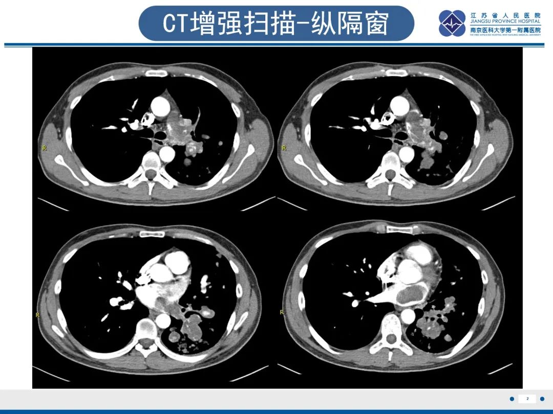 影像PPT - 【PPT】肺动脉内膜肉瘤-3
