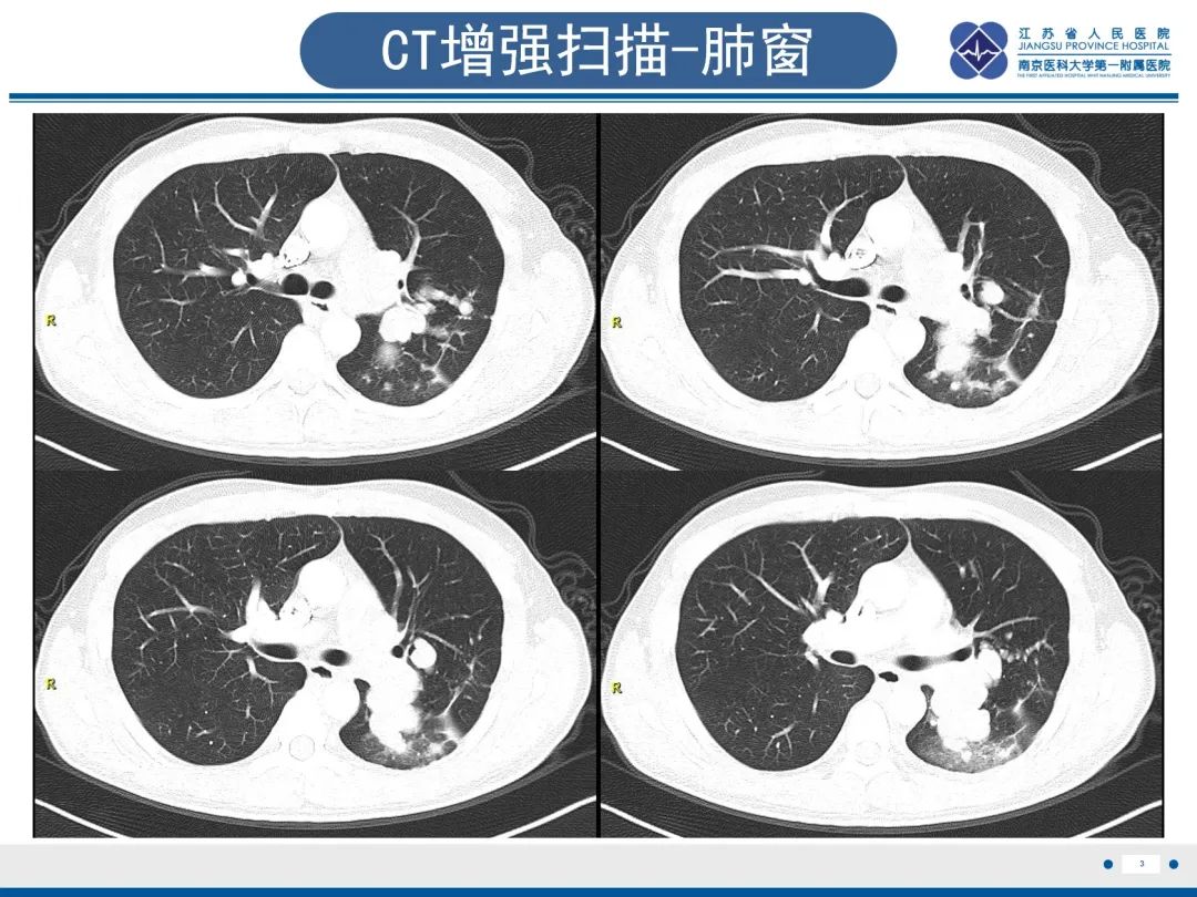 影像PPT - 【PPT】肺动脉内膜肉瘤-4