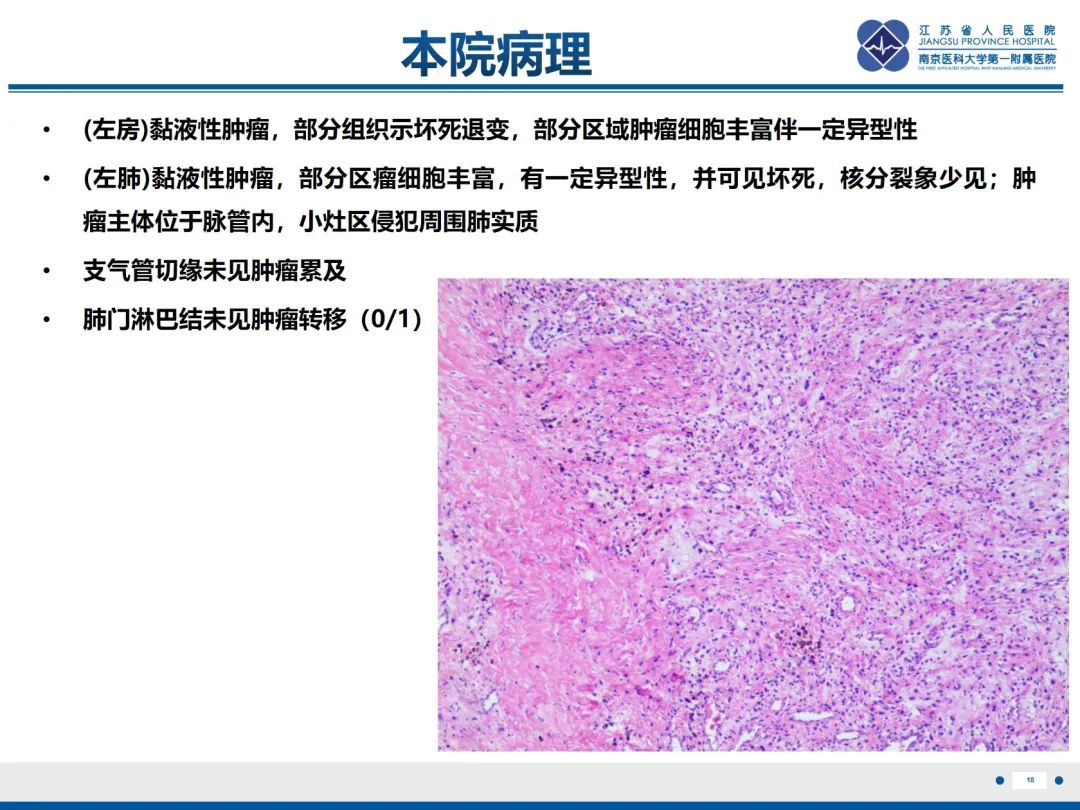 影像PPT - 【PPT】肺动脉内膜肉瘤-19