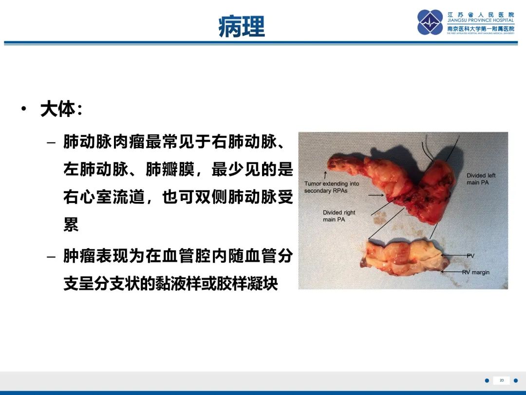 影像PPT - 【PPT】肺动脉内膜肉瘤-24