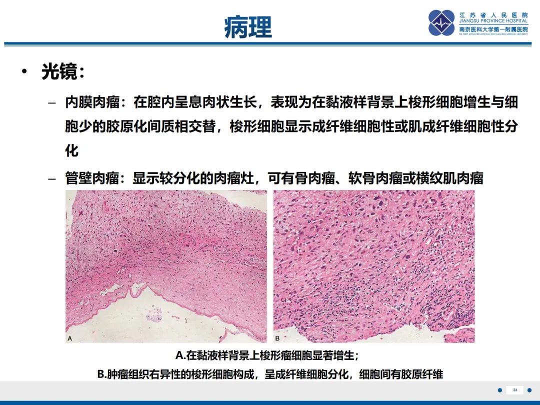 影像PPT - 【PPT】肺动脉内膜肉瘤-25