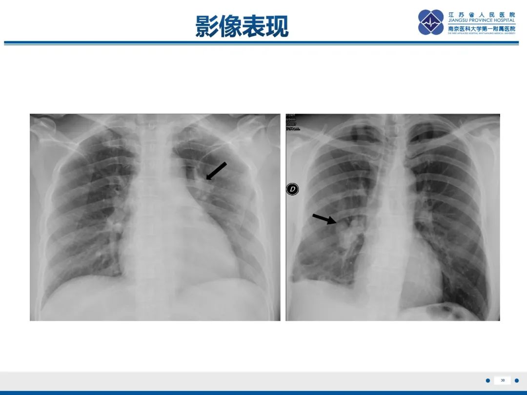影像PPT - 【PPT】肺动脉内膜肉瘤-31