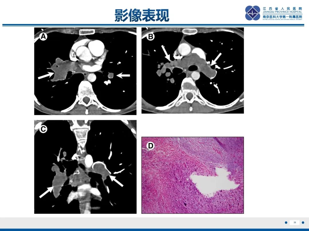 影像PPT - 【PPT】肺动脉内膜肉瘤-33