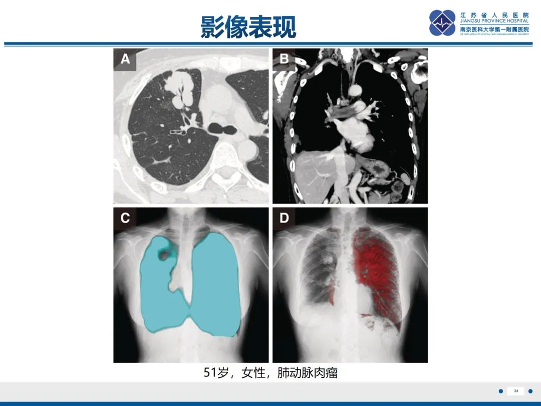 影像PPT - 【PPT】肺动脉内膜肉瘤-35