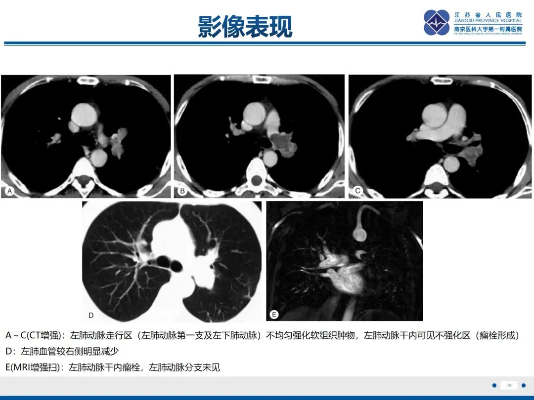 影像PPT - 【PPT】肺动脉内膜肉瘤-34