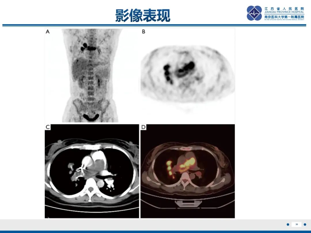 影像PPT - 【PPT】肺动脉内膜肉瘤-37