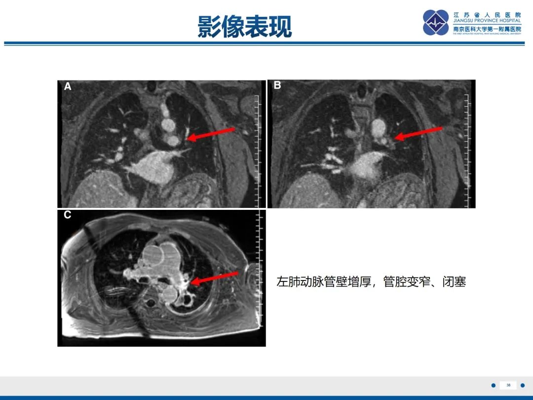 影像PPT - 【PPT】肺动脉内膜肉瘤-39