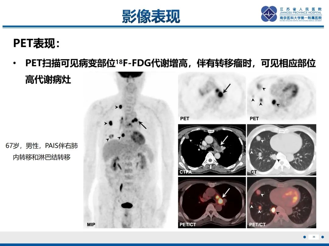 影像PPT - 【PPT】肺动脉内膜肉瘤-36
