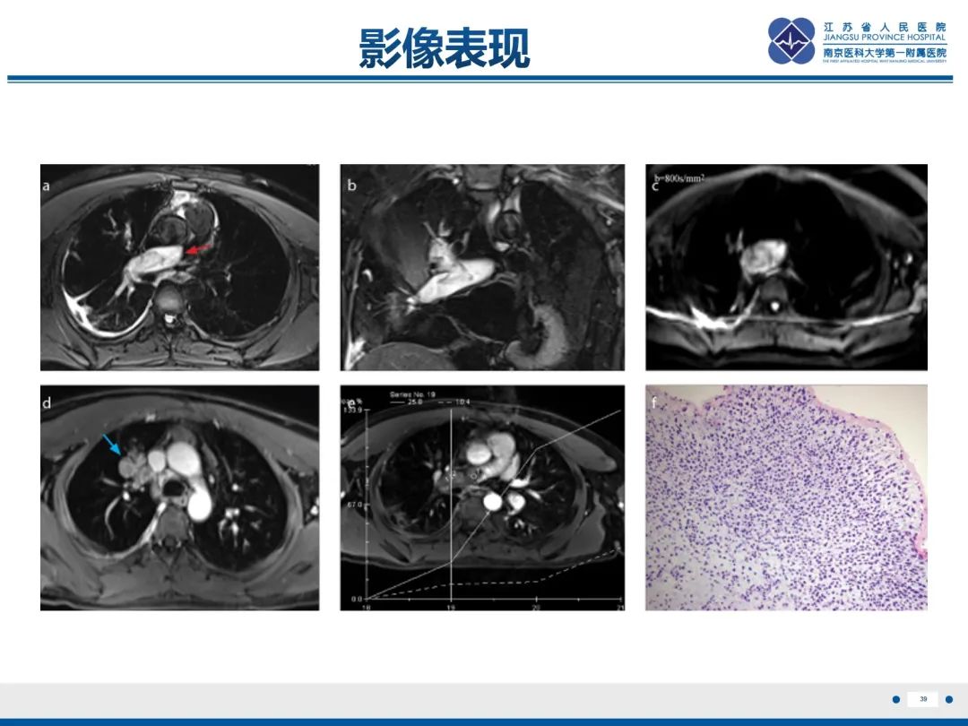 影像PPT - 【PPT】肺动脉内膜肉瘤-40