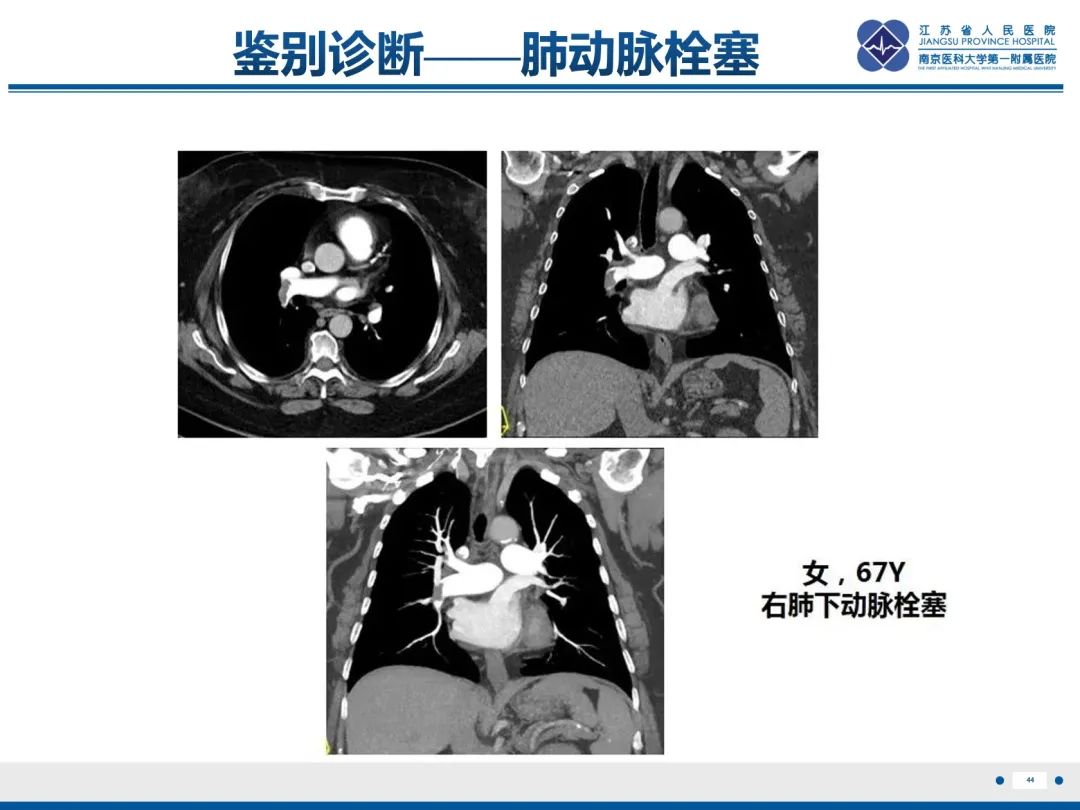 影像PPT - 【PPT】肺动脉内膜肉瘤-45