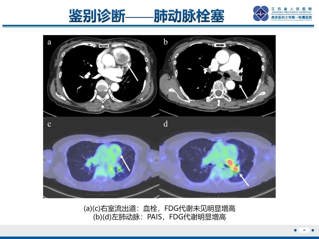 影像PPT - 【PPT】肺动脉内膜肉瘤-46