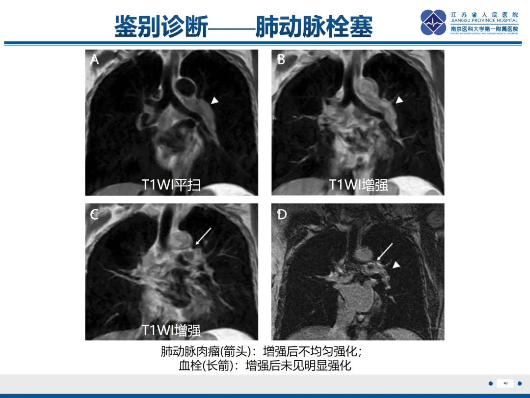 影像PPT - 【PPT】肺动脉内膜肉瘤-47