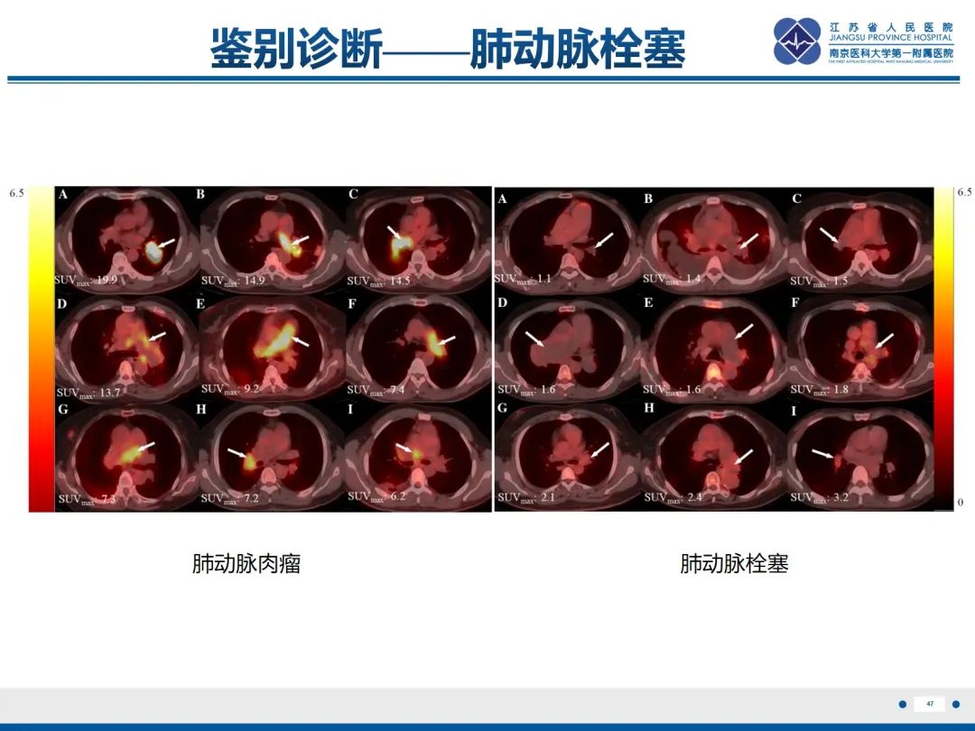 影像PPT - 【PPT】肺动脉内膜肉瘤-48