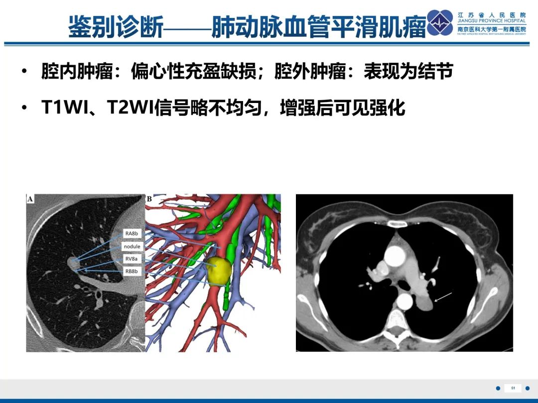 影像PPT - 【PPT】肺动脉内膜肉瘤-52