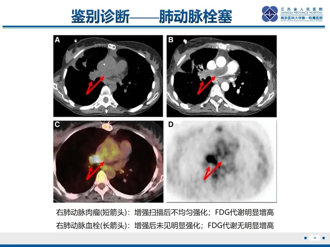影像PPT - 【PPT】肺动脉内膜肉瘤-49