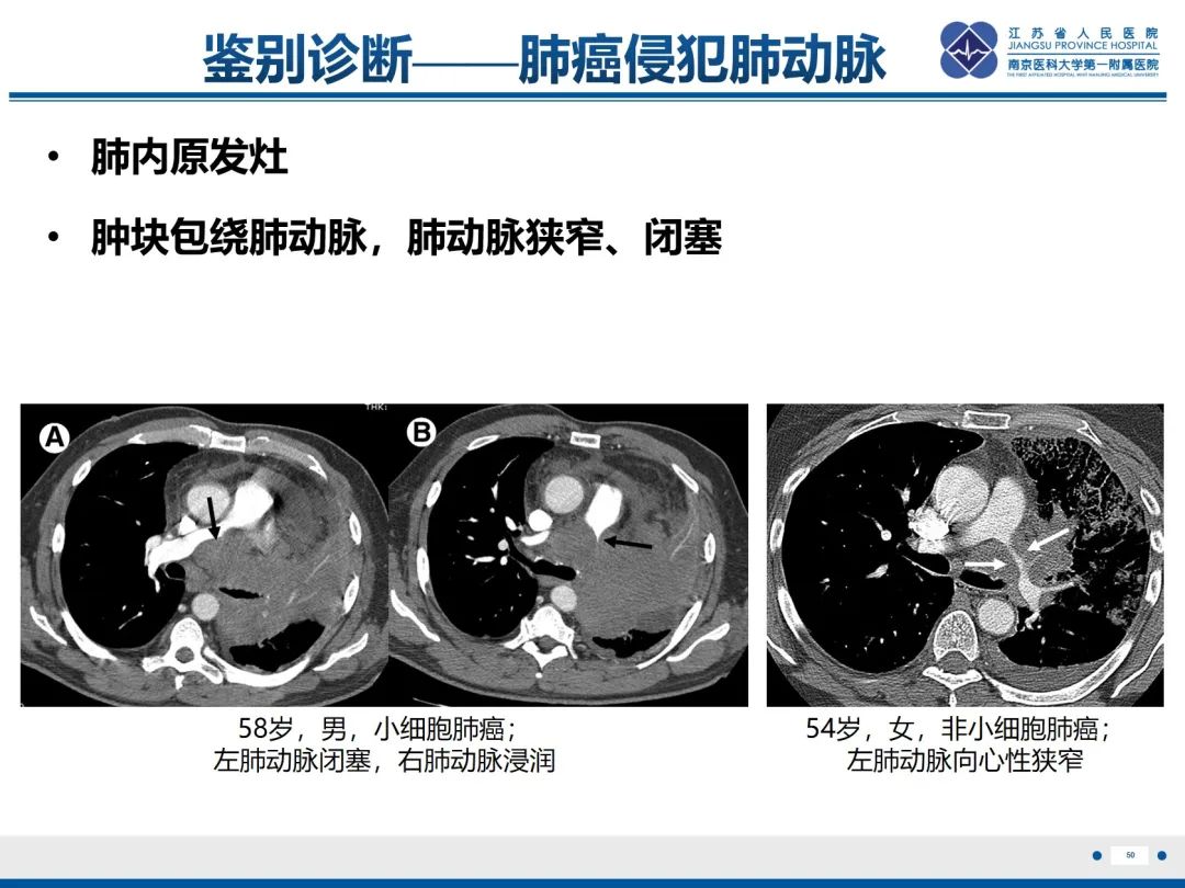 影像PPT - 【PPT】肺动脉内膜肉瘤-51