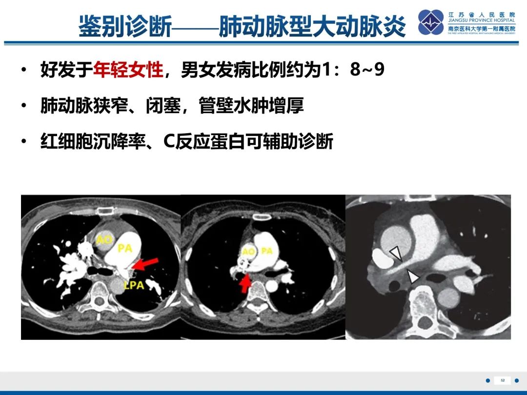 影像PPT - 【PPT】肺动脉内膜肉瘤-53