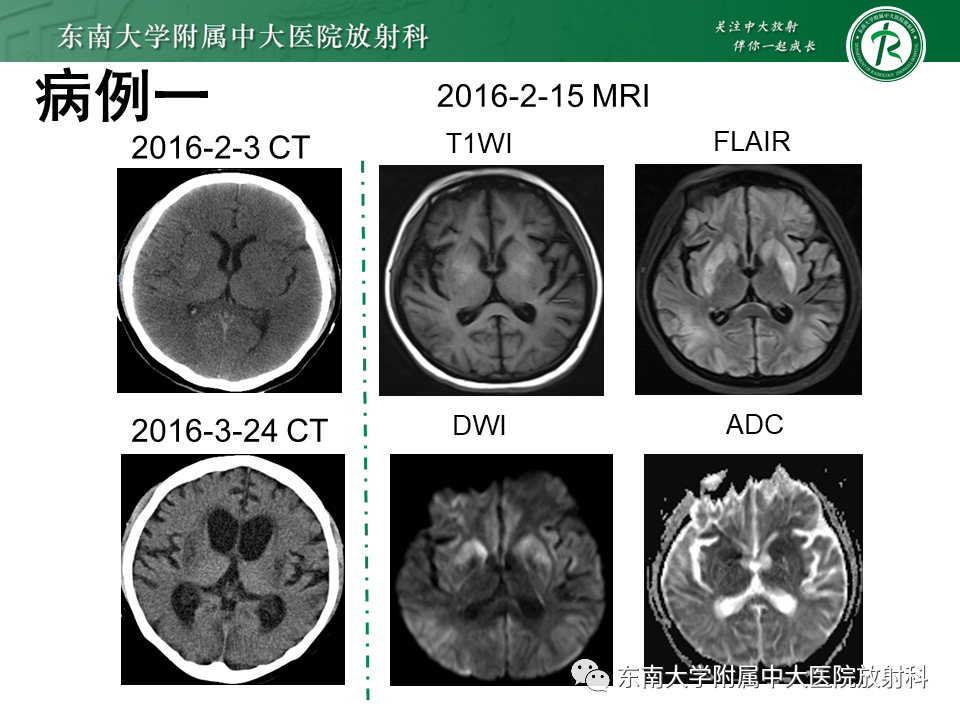 影像PPT - 【PPT】双基底节区病变影像诊断-2