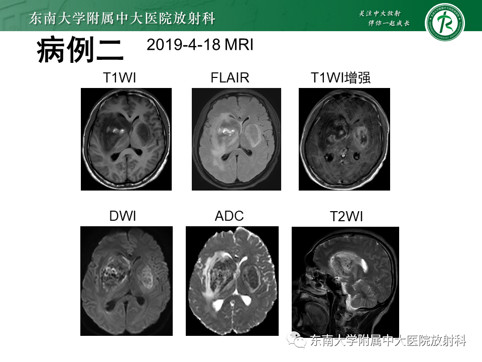 影像PPT - 【PPT】双基底节区病变影像诊断-4