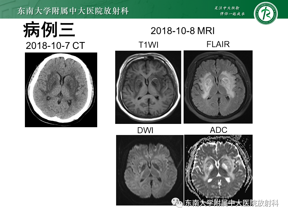 影像PPT - 【PPT】双基底节区病变影像诊断-6