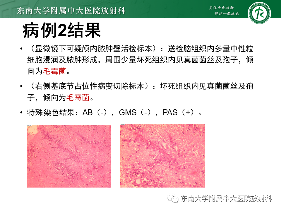 影像PPT - 【PPT】双基底节区病变影像诊断-10