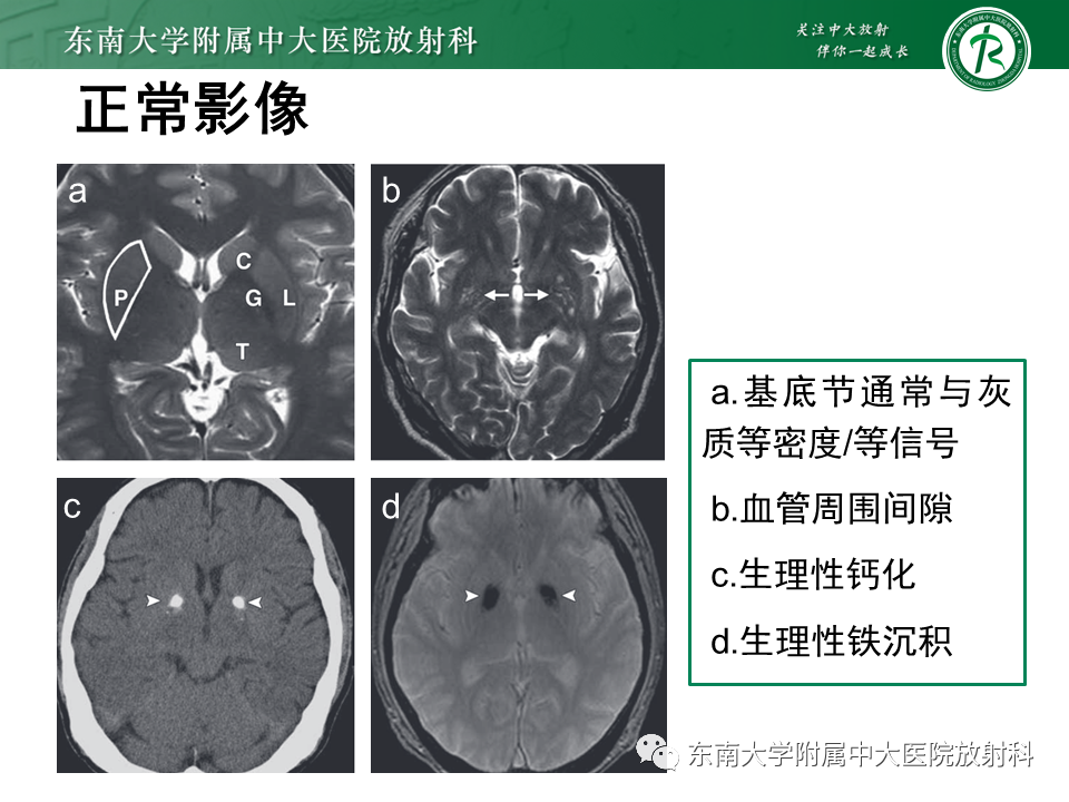 影像PPT - 【PPT】双基底节区病变影像诊断-18
