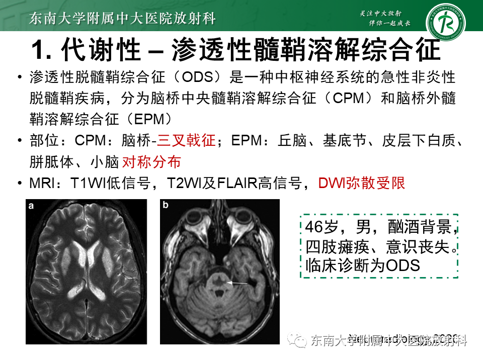影像PPT - 【PPT】双基底节区病变影像诊断-23