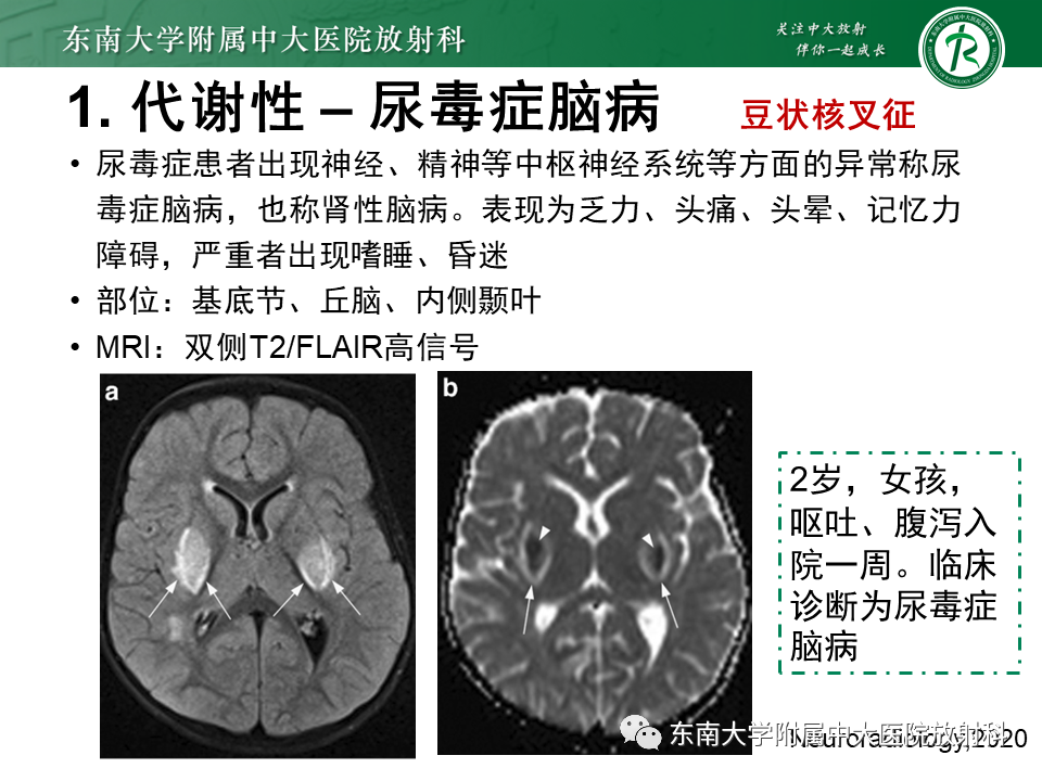影像PPT - 【PPT】双基底节区病变影像诊断-24