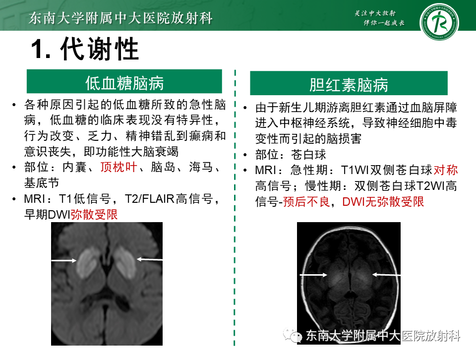 影像PPT - 【PPT】双基底节区病变影像诊断-26