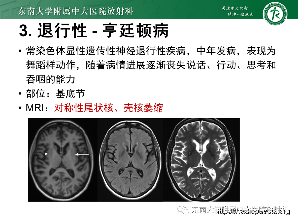 影像PPT - 【PPT】双基底节区病变影像诊断-28