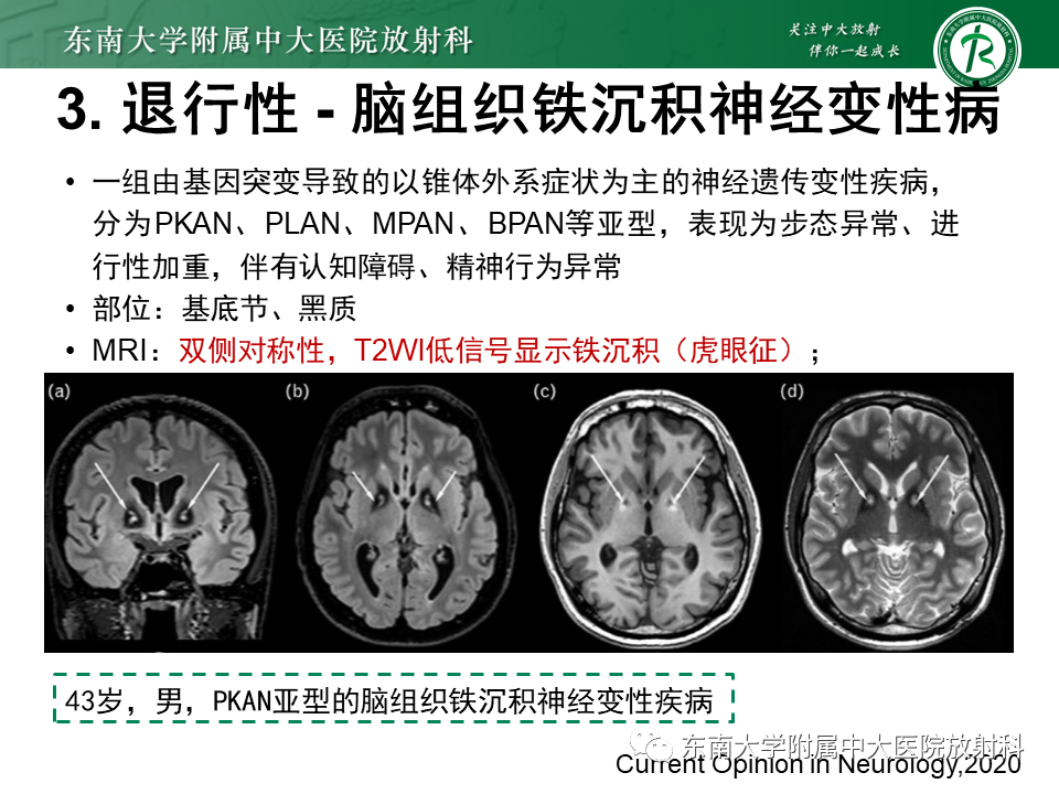 影像PPT - 【PPT】双基底节区病变影像诊断-29