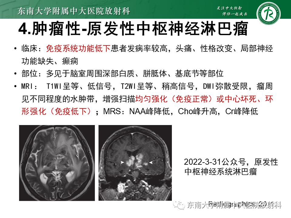 影像PPT - 【PPT】双基底节区病变影像诊断-30