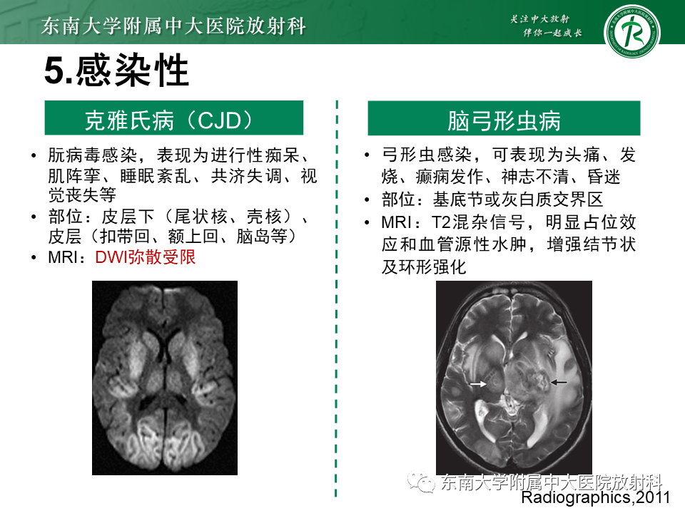 影像PPT - 【PPT】双基底节区病变影像诊断-32