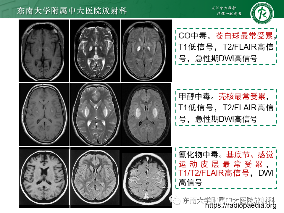影像PPT - 【PPT】双基底节区病变影像诊断-34