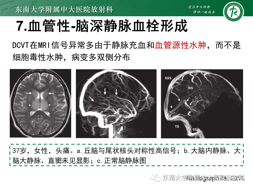 影像PPT - 【PPT】双基底节区病变影像诊断-36