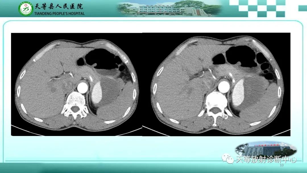 影像PPT - 【病例】脾脏假性动脉瘤1例CT影像-10 影像PPT - 【病例】脾脏假性动脉瘤1例CT影像-10