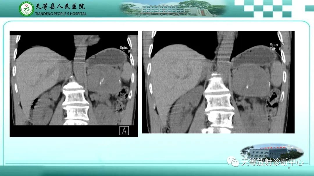 影像PPT - 【病例】脾脏假性动脉瘤1例CT影像-8 影像PPT - 【病例】脾脏假性动脉瘤1例CT影像-8